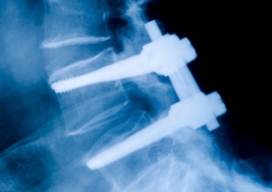 Spinal Implant Testing